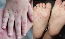 Virus de Coxsackie, 5 cosas que debes saber