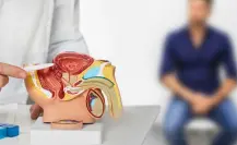 Cáncer de Próstata: Esto es lo que debes saber sobre su detección y prevención