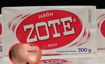 ¿El jabón de Zote es una alternativa para el acné? Esto debes saber