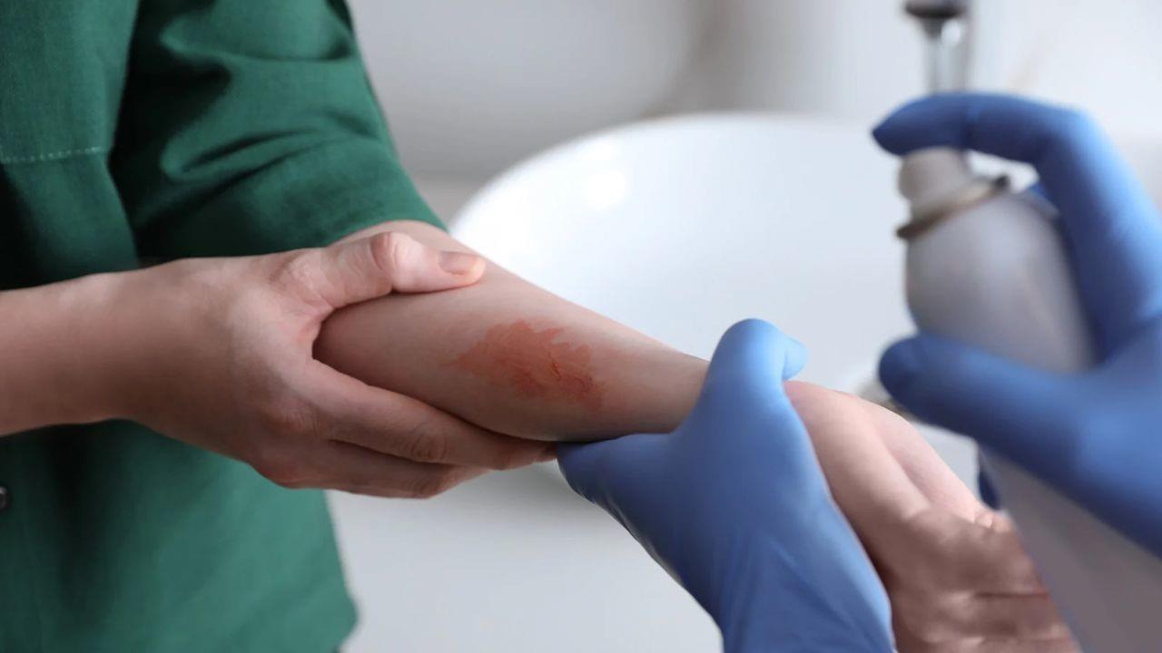 IMSS brinda consejos para tratar quemaduras por pirotecnia. Foto: Canva.