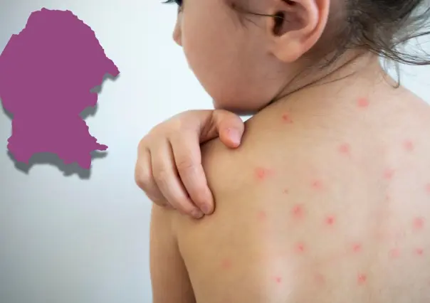 Varicela en Coahuila: ¿Cuánto tiempo se deben aislar las personas enfermas?