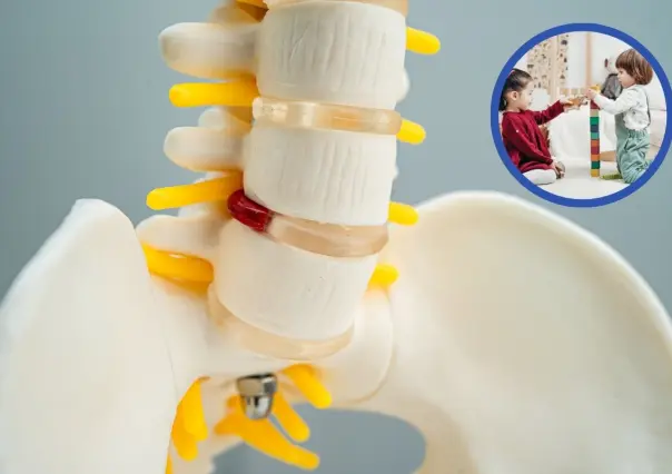 Christus Muguerza Coahuila ofrece cirugías pediátricas para pacientes con escoliosis