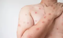 Emiten alerta por casos de Mpox detectados en asistentes a festival en Zipolite, Oaxaca