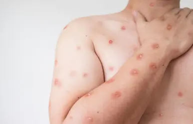 Emiten alerta por casos de Mpox detectados en asistentes a festival en Zipolite, Oaxaca