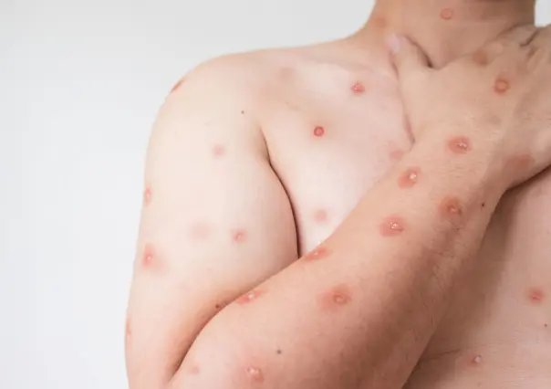 Emiten alerta por casos de Mpox detectados en asistentes a festival en Zipolite, Oaxaca