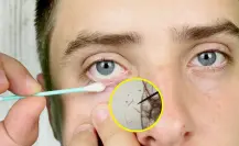 ¿Cómo acabar con los ácaros que invaden las pestañas?