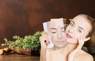 ¿Rostro sin acné? Esta hierba medicinal combate la bacteria que lo causa y regenera la piel