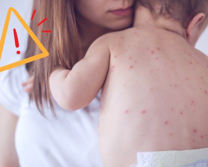 Alerta epidemiológica por aumento de casos de sarampión