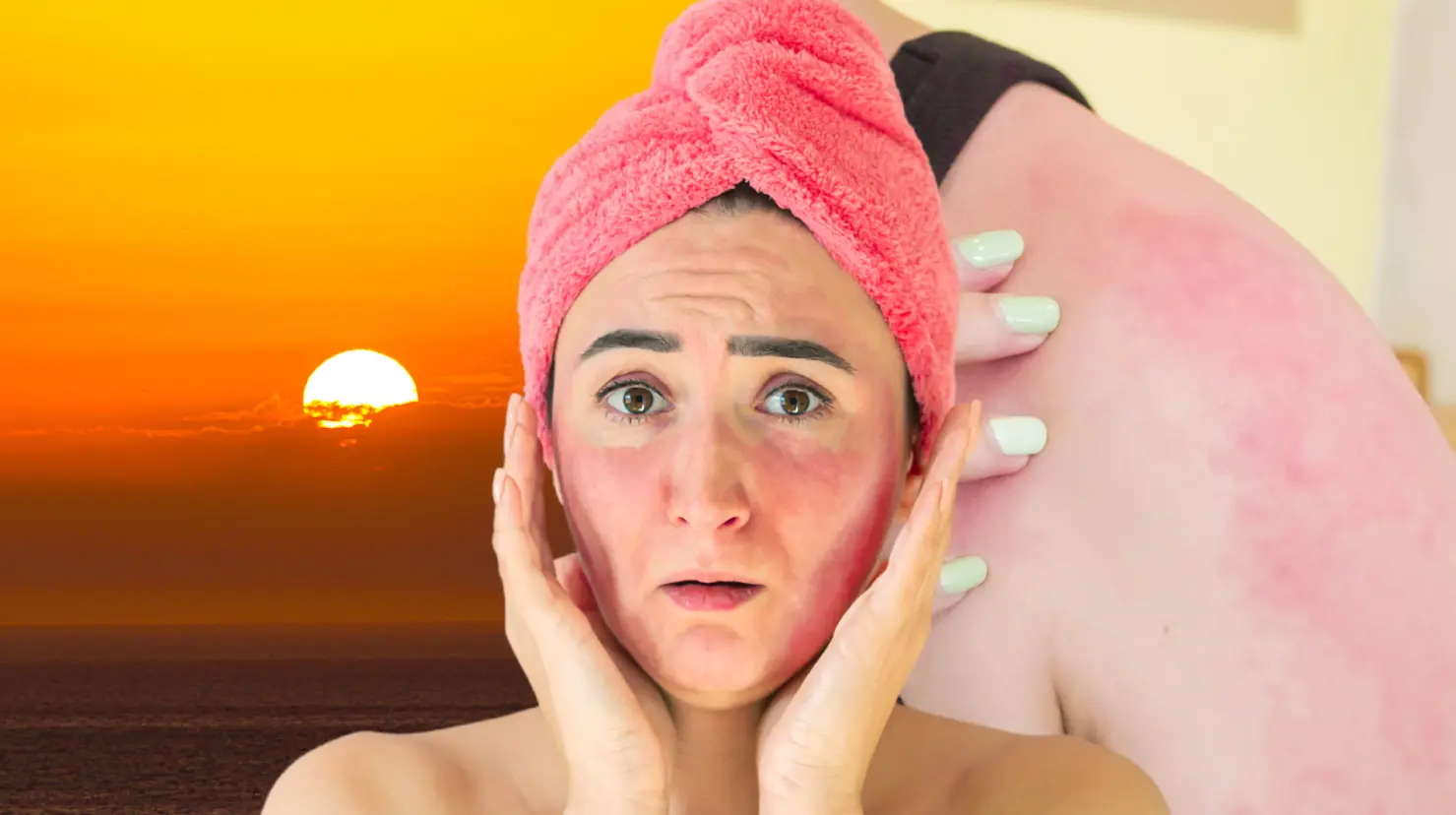 ¿Te quemaste con el sol? Esta mascarilla te ayudará a calmar tu piel. Foto: Canva.