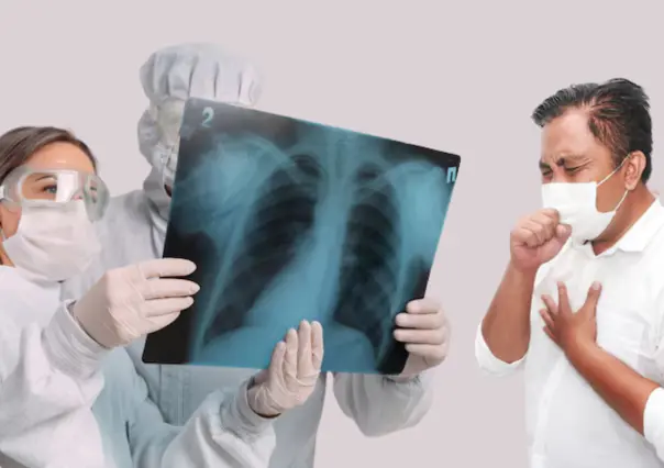 El contagio de tuberculosis disminuye en el municipio de Reynosa