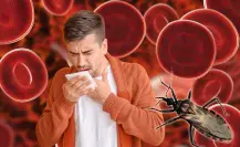 ¿Cuáles son los síntomas de la enfermedad de Chagas y cómo se contagia?