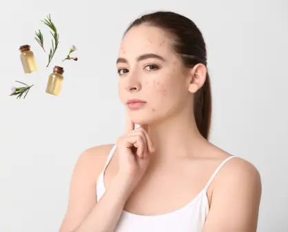 ¡Bueno, bonito y barato! Este remedio casero eliminará el acné y los puntos negros de tu rostro