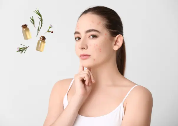 ¡Bueno, bonito y barato! Este remedio casero eliminará el acné y los puntos negros de tu rostro