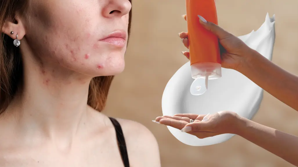 ¿El protector solar provoca acné? Esto dicen los dermatólogos