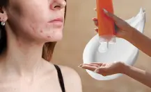 ¿El protector solar provoca acné? Esto dicen los dermatólogos