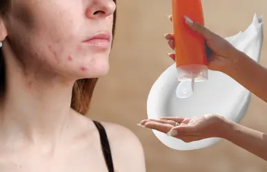 ¿El protector solar provoca acné? Esto dicen los dermatólogos
