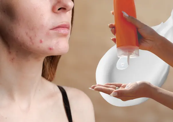 ¿El protector solar provoca acné? Esto dicen los dermatólogos