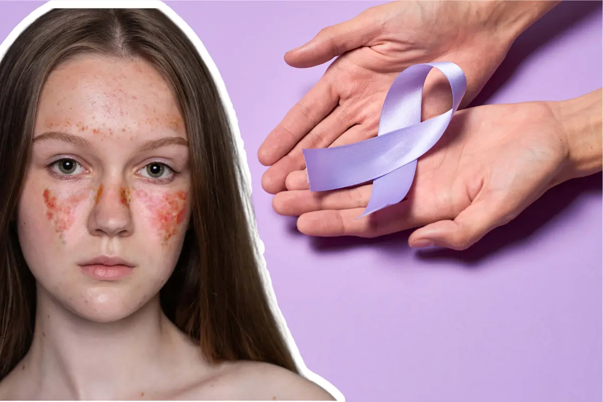 El lupus no tiene cura, pero existen tratamientos que ayudan a controlar los brotes y mejorar la calidad de vida de quienes lo enfrentan./Foto: Colegio Mexicano de Reumatología/ Canva