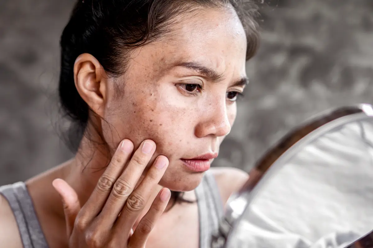 El paño facial no solo es por la edad, también problemas hormonales pueden ser la causa. Foto: Canva