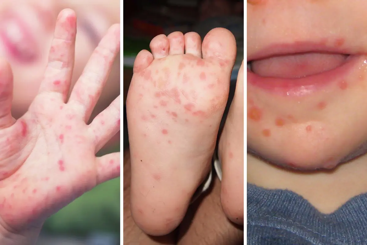 La enfermedad de manos, pies y boca es altamente contagiosa y los más susceptibles son los menores. Foto: Carlos García