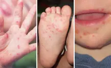¿Qué es la enfermedad de manos, pies y boca en niños y por qué Salud ha reforzado su vigilancia?