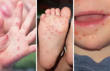 ¿Qué es la enfermedad de manos, pies y boca en niños y por qué Salud ha reforzado su vigilancia?