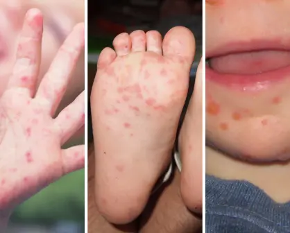¿Qué es la enfermedad de manos, pies y boca en niños y por qué Salud ha reforzado su vigilancia?