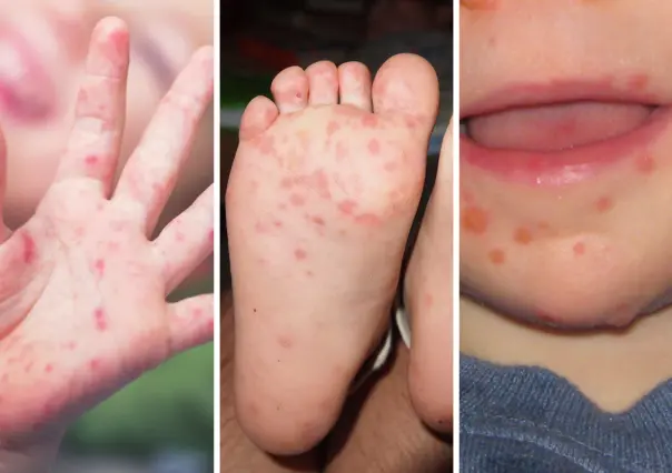 ¿Qué es la enfermedad de manos, pies y boca en niños y por qué Salud ha reforzado su vigilancia?