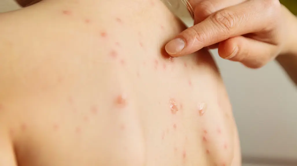 Con nueve casos, Tamaulipas ya es cuarto lugar nacional en contagios de sarampión