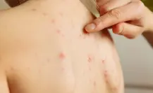 Con nueve casos, Tamaulipas ya es cuarto lugar nacional en contagios de sarampión