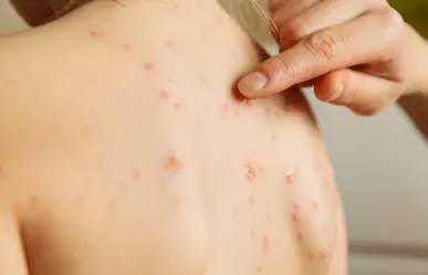 Con nueve casos, Tamaulipas ya es cuarto lugar nacional en contagios de sarampión