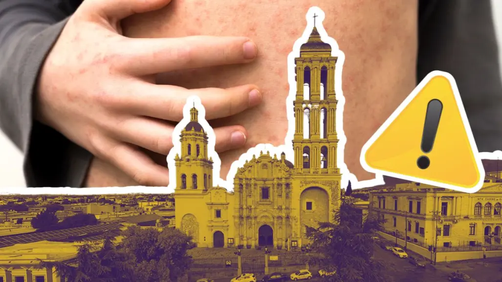 Coahuila en alerta: confirman primer caso de Sarampión en Saltillo