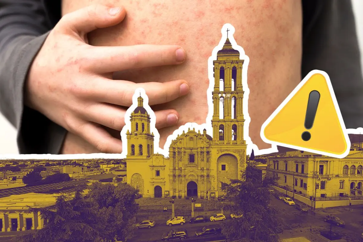 Confirman primer caso de Sarampión en Saltillo, despliegan alerta en Coahuila / Foto: Archivo POSTA Mx | Canva
