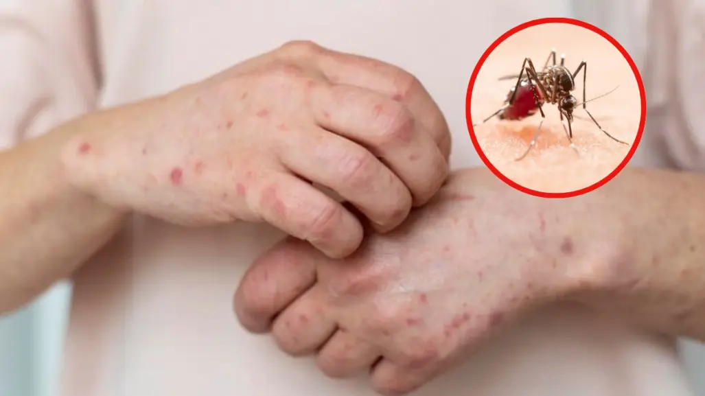 Alertan sobre el dengue, el sarampión y padecimientos por calor en Tamaulipas