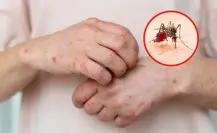 Alertan sobre el dengue, el sarampión y padecimientos por calor en Tamaulipas