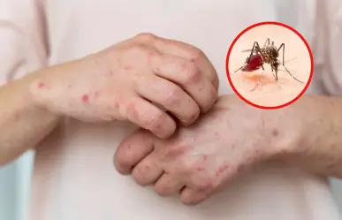 Alertan sobre el dengue, el sarampión y padecimientos por calor en Tamaulipas