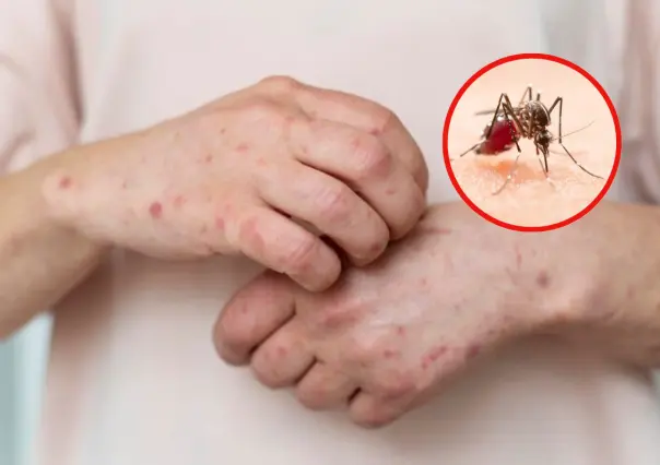 Alertan sobre el dengue, el sarampión y padecimientos por calor en Tamaulipas