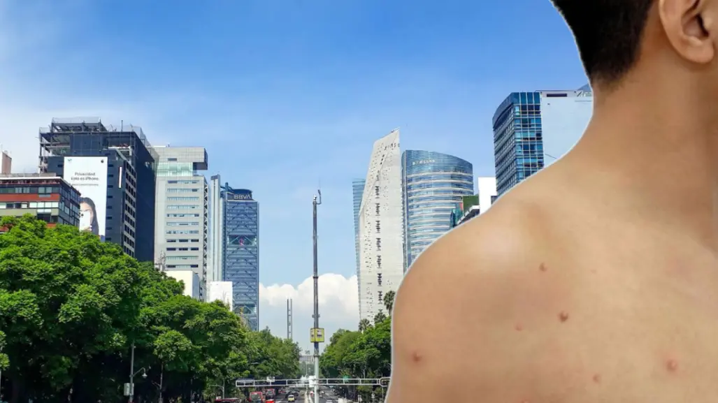 Viruela del mono se expande en CDMX: casos aumentan 20 veces en lo que del 2025