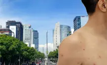 Viruela del mono se expande en CDMX: casos aumentan 20 veces en lo que del 2025