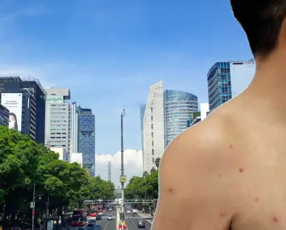 Viruela del mono se expande en CDMX: casos aumentan 20 veces en lo que del 2025