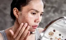 Guía práctica para desaparecer manchas por el sol con este remedio natural