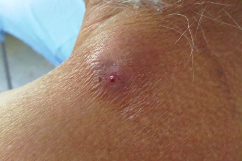 Miasis en humanos. Foto: Wikipedia
