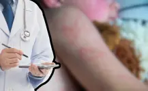 Confirma Salud BCS 3 casos de sarampión en Comondú