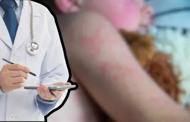 Confirma Salud BCS 3 casos de sarampión en Comondú
