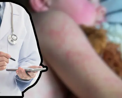 Confirma Salud BCS 3 casos de sarampión en Comondú