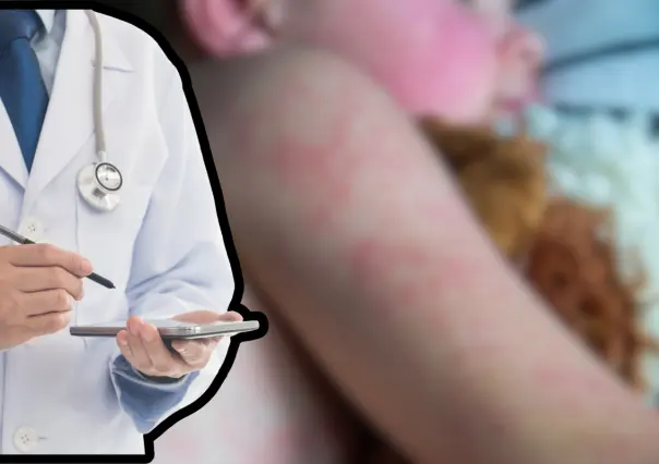 Confirma Salud BCS 3 casos de sarampión en Comondú