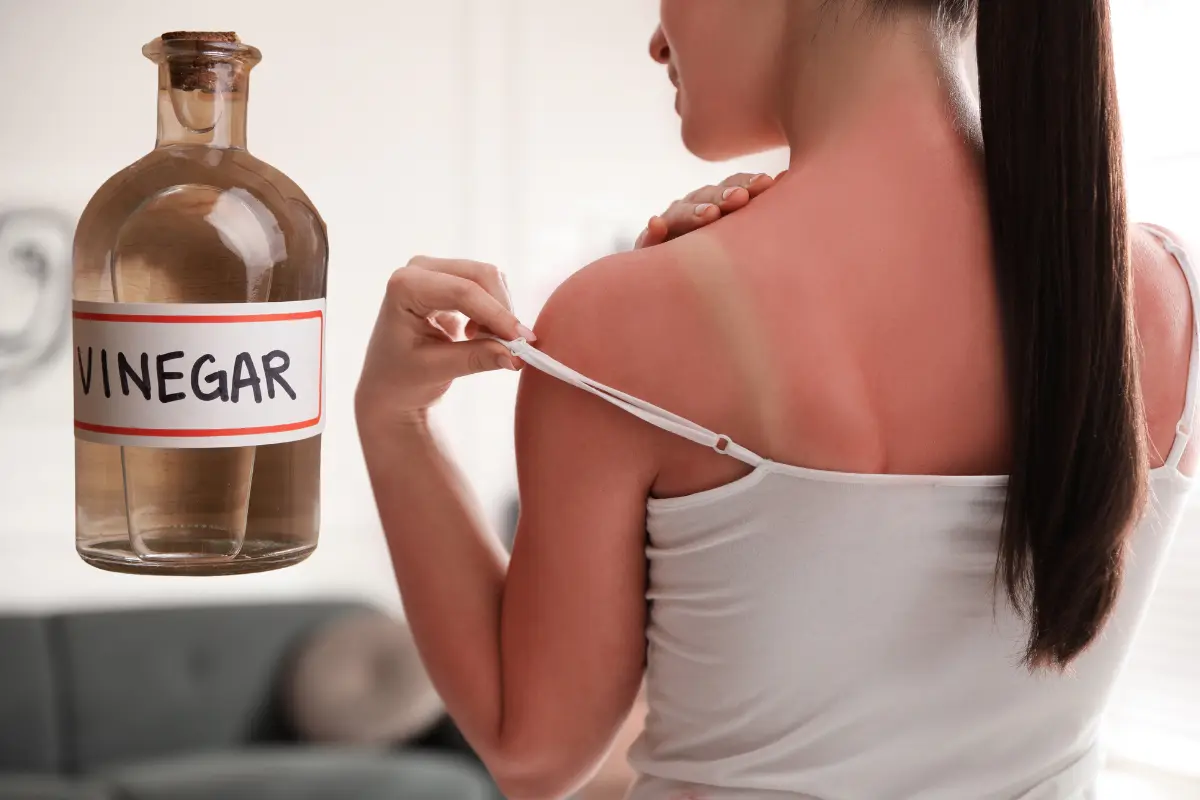 El vinagre tiene propiedades que ayudan a evitar infecciones en la piel dañada por la quemadura solar. Foto: Canva