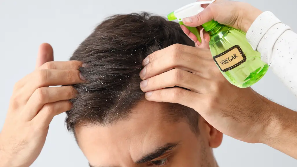 El Vinagre blanco es un remedio natural y económico contra la caspa