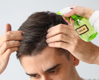 El Vinagre blanco es un remedio natural y económico contra la caspa