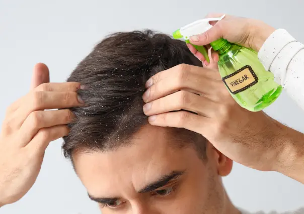 El Vinagre blanco es un remedio natural y económico contra la caspa